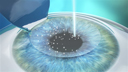 reshaping the cornea to correct defects in the visual system