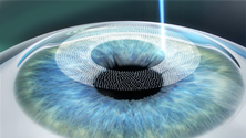 image showin creation of a cornea ﬂap in bladeless LASIK surgery